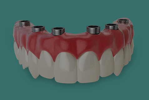 Próteses dentárias de um único molar projetadas por IA